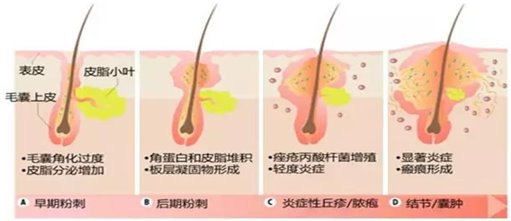 痤瘡發(fā)生機(jī)制